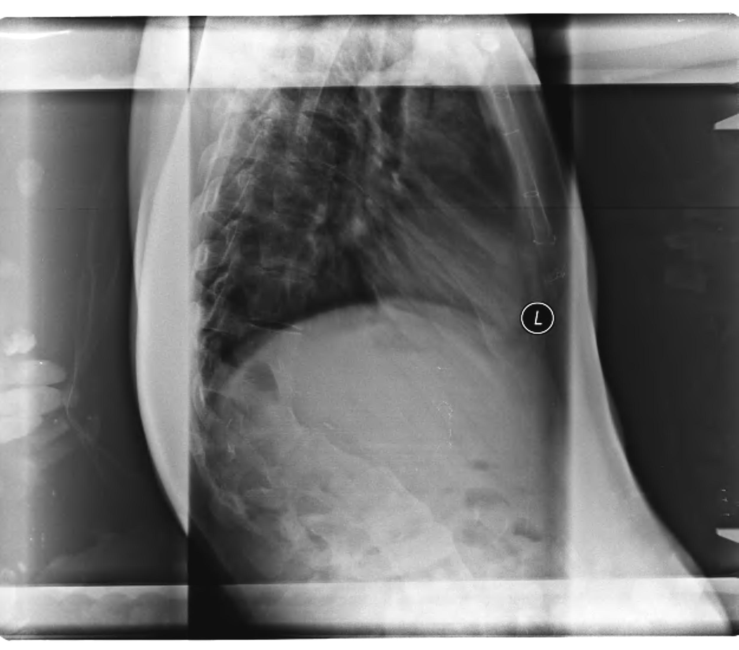 Congenital Kyphosis Xray